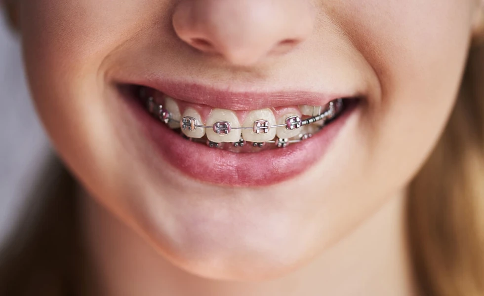 Multi-bagues métalliques orthodontie adolescent au Cabinet Orthodontie du Dr Florent Aubert, situé à Martigues 13500