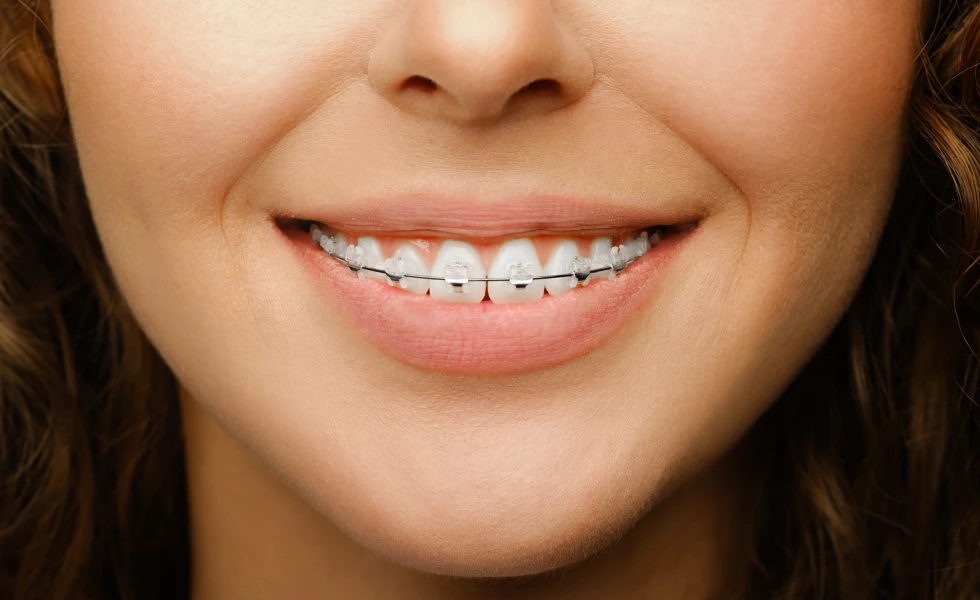 Multi-bagues métalliques, multi-bagues céramiques, orthodontie adulte, adolescent au Cabinet d'orthodontie du Dr Aubert, Martigues 13500